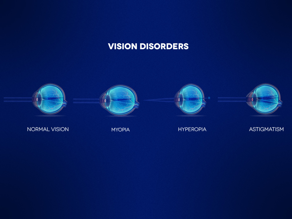 Refractive Error Orbit Eye Hospital Mumbai